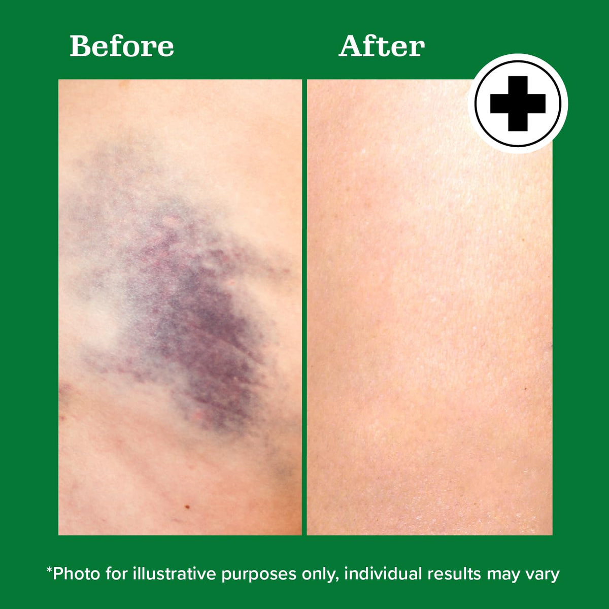 Miracle Plus Natural Arnica Bruise Body Gel | Arnica Montana Lotion For Thin Skin Bruising And