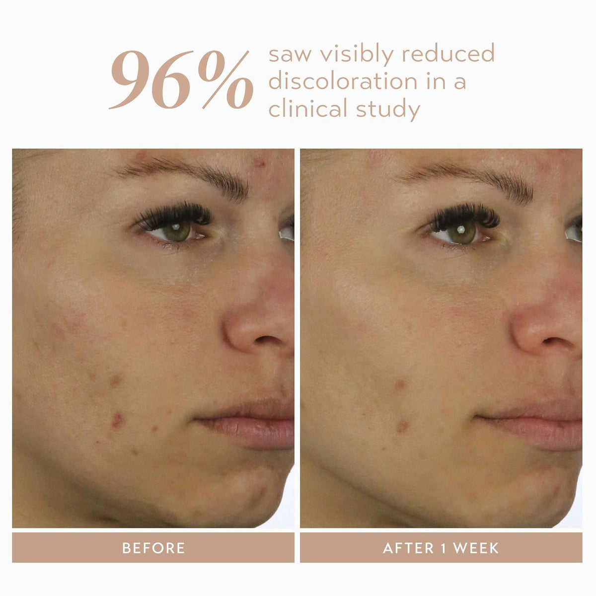 Shani Darden Rescue Serum with 10% Azelaic Complex, Lightweight Hydrating Azelaic Acid Serum for