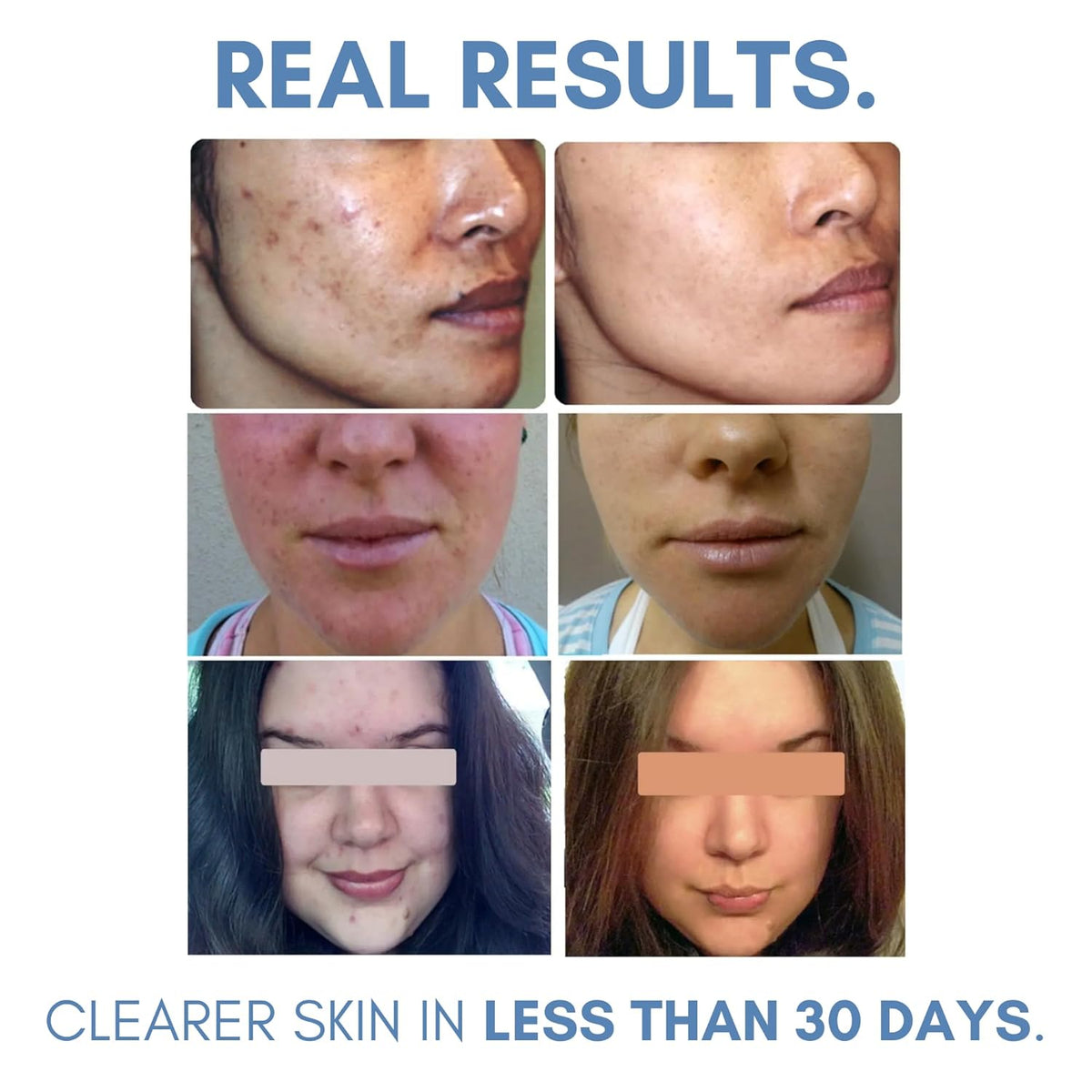 Clarifying Toner for Acne and Blemishes, Face Toner, Facial Toner, Skin Toner, Acne Toner, Toner
