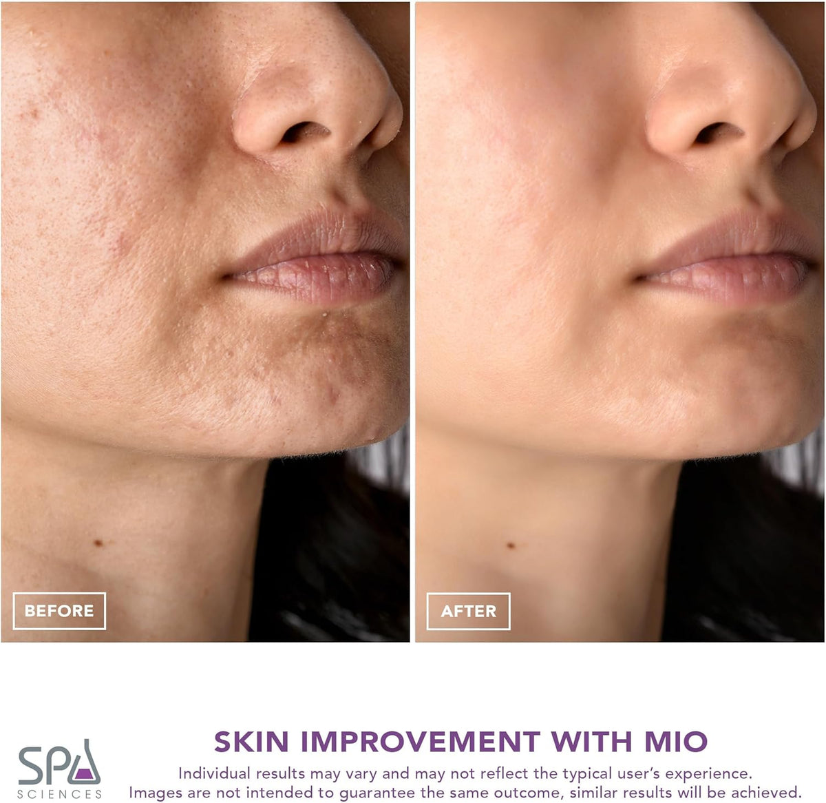 Spa Sciences - MIO - Diamond Tip Microdermabrasion Blackhead Remover, Pore Cleansing, & Resurfacing