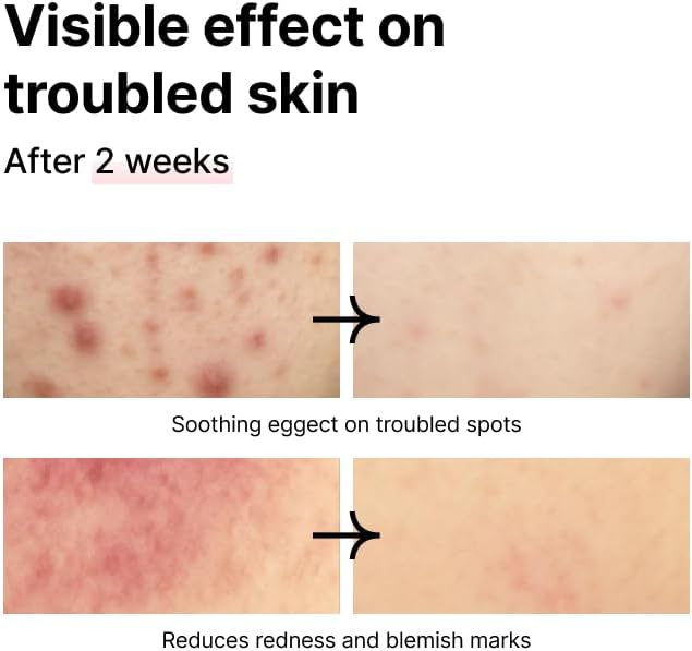 PINKWONDER Tamanu Hero Mineral Salt Essence Toner | All-in-One Blemish Solution | Instant Cooling &