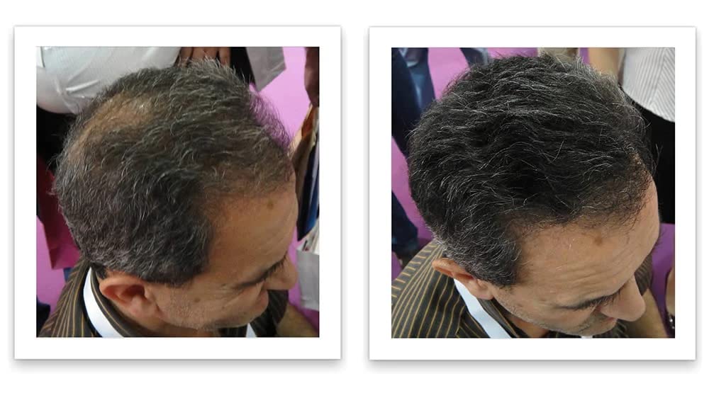 Caboki Hair Loss Concealer. All-Natural Hair Building Fiber. Make Thin Hair Look 10X Fuller