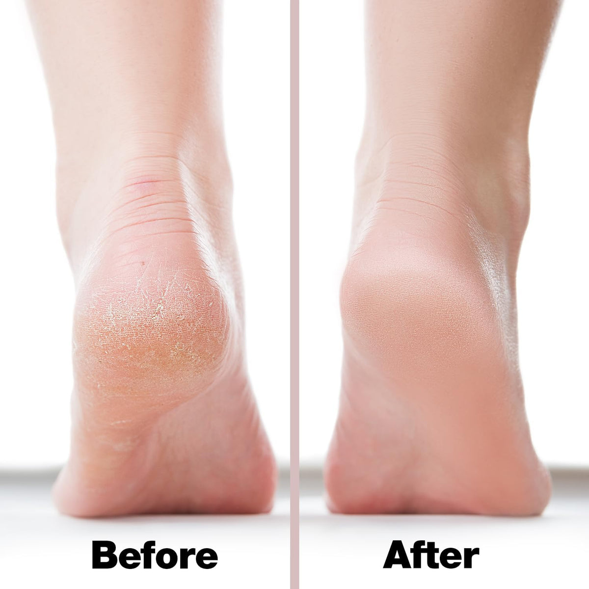 Probelle Double Sided Multidirectional Nickel Foot File Callus Remover - Immediately Reduces