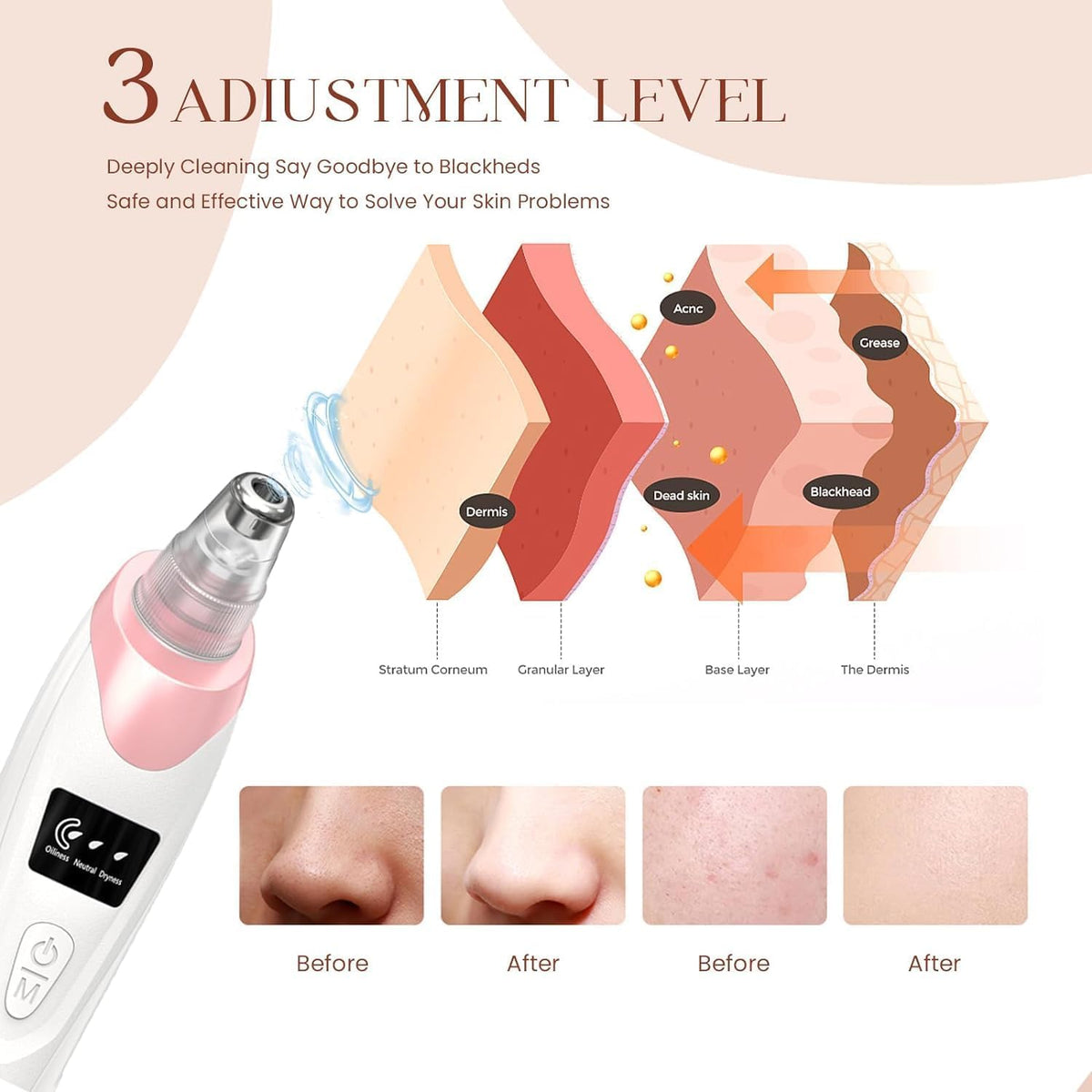 2025 Blackhead Remover Pore Vacuum,Facial Pore Cleaner-5 Suction Power,5 Probes,USB Rechargeable