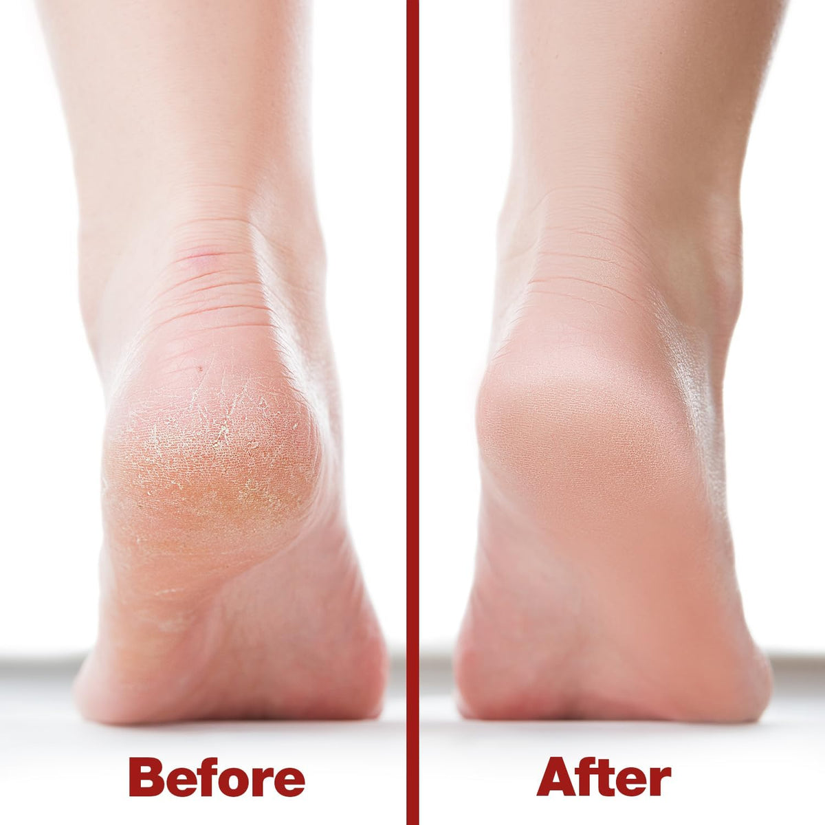 Probelle Double Sided Multidirectional Nickel Foot File Callus Remover - Immediately Reduces