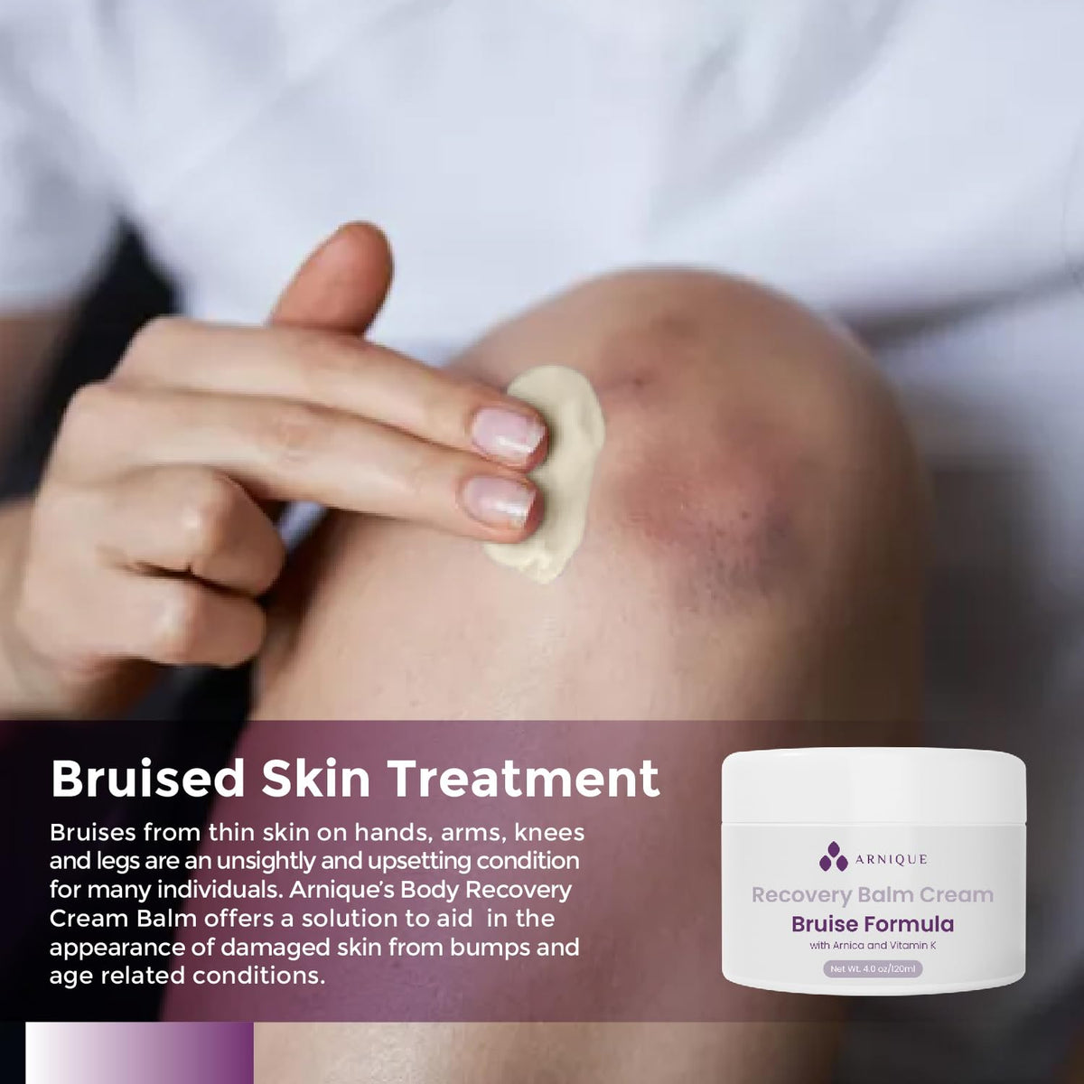 Arnica Bruise Cream with Vitamin K, Extra Strength Fast Healing Thin Skin Formula, Senile Purpura