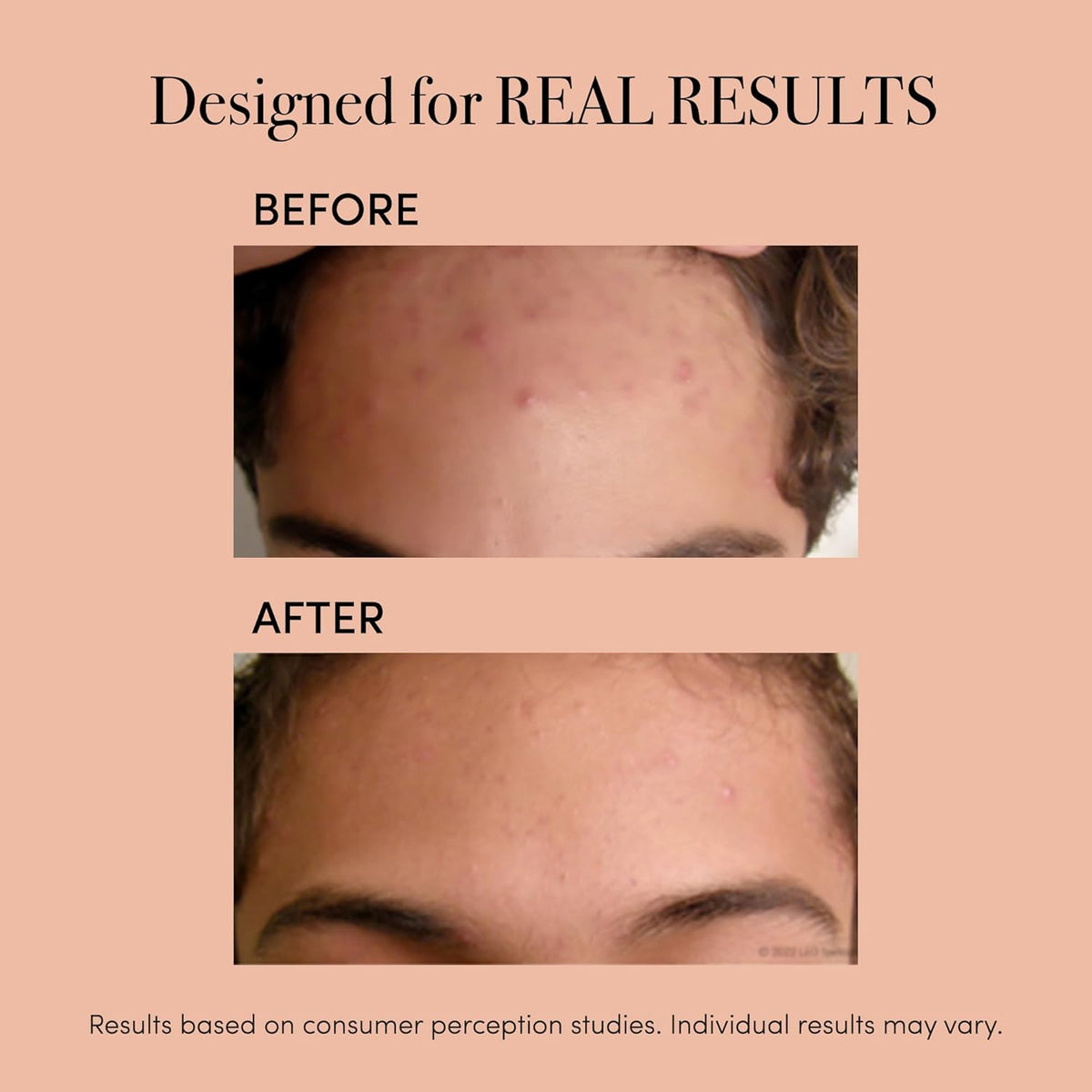 reVive Light Therapy Clinical Acne Treatment for Face, Blue Light Therapy Device