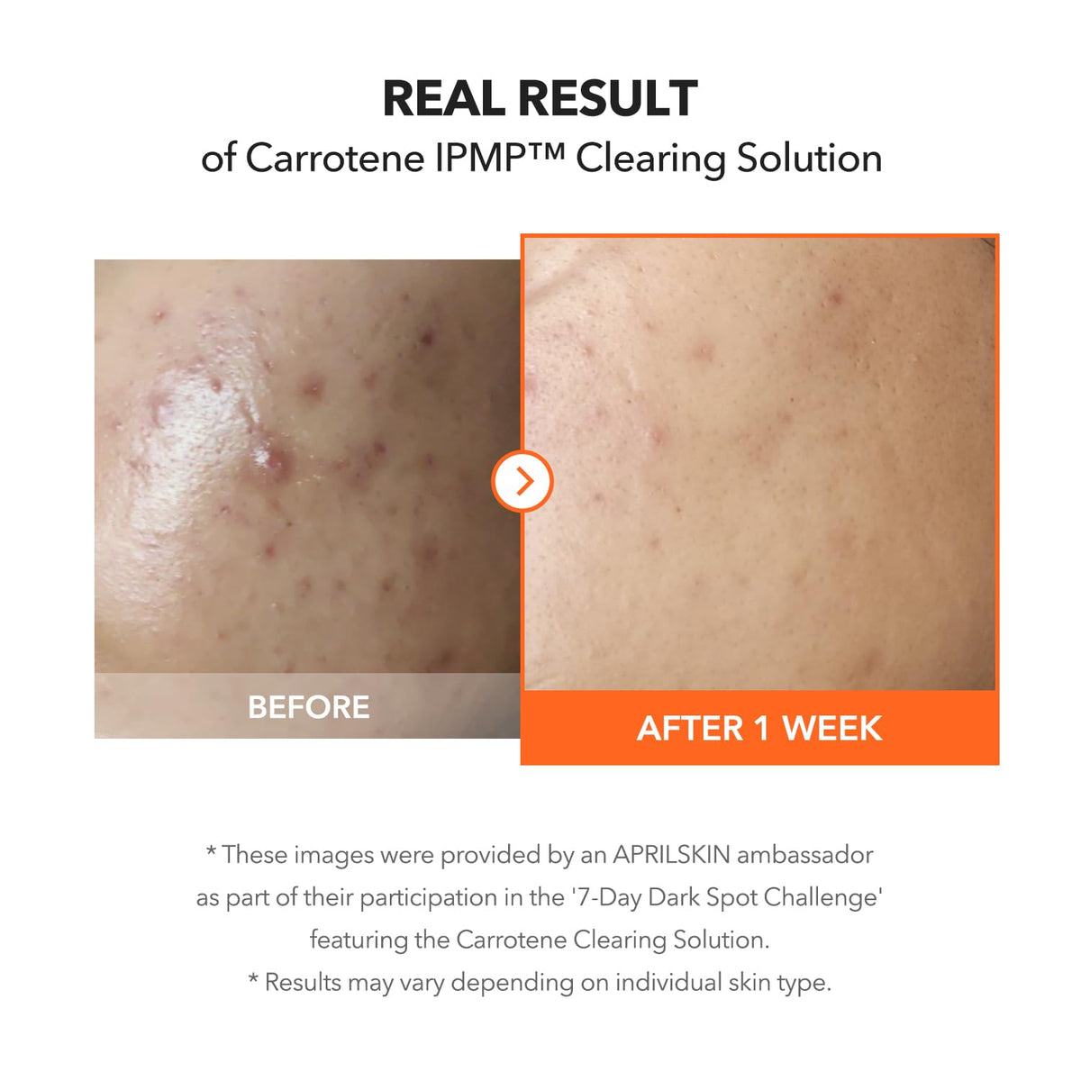 APRILSKIN Carrotene IPMP™ Clearing Solution || Quickly soothes troubled areas and helps clear