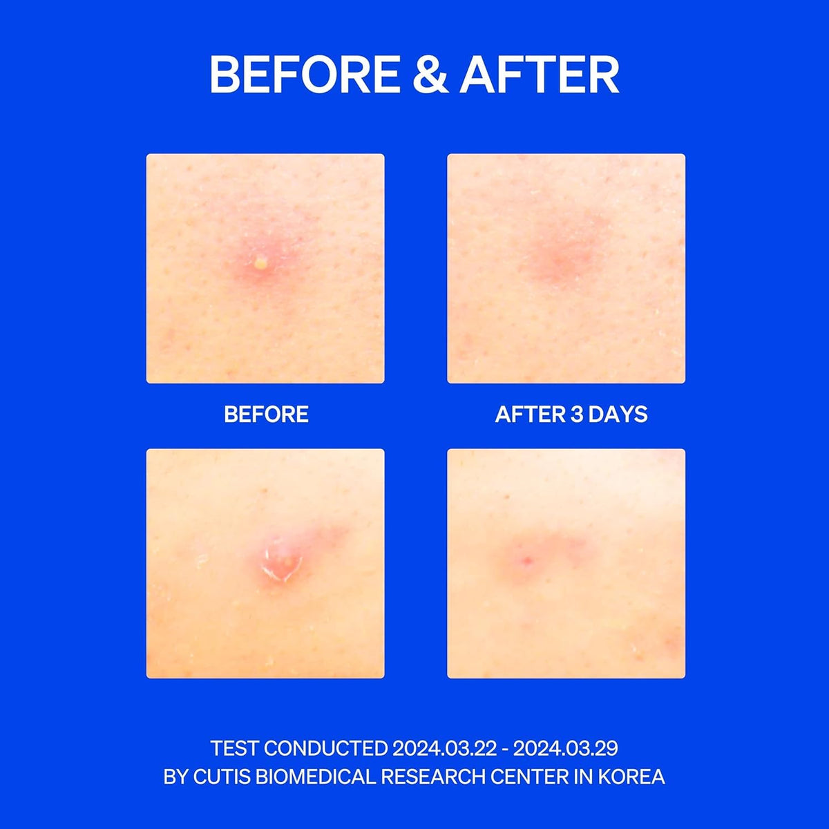 RIGHT AWAY Microtip Hydrocolloid Acne Pimple Patch for Early Stage Zits and Hidden Blemish (8