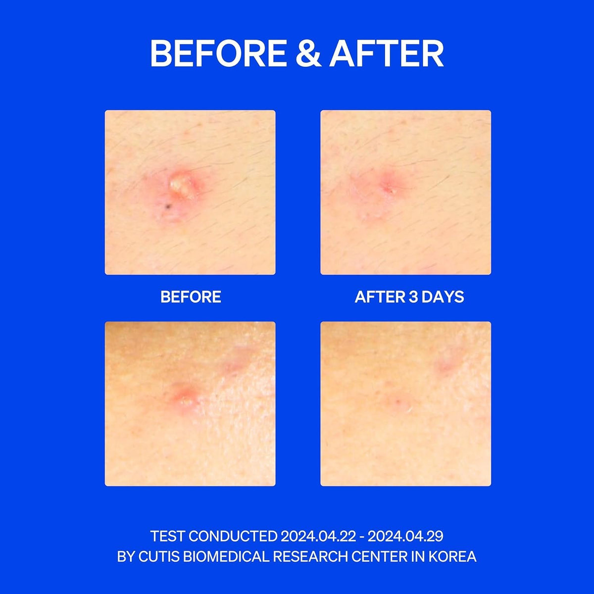 Right Away Thincognito Invisible Spot Patch - Absorbing Hydrocolloid Pimple Patch for Face