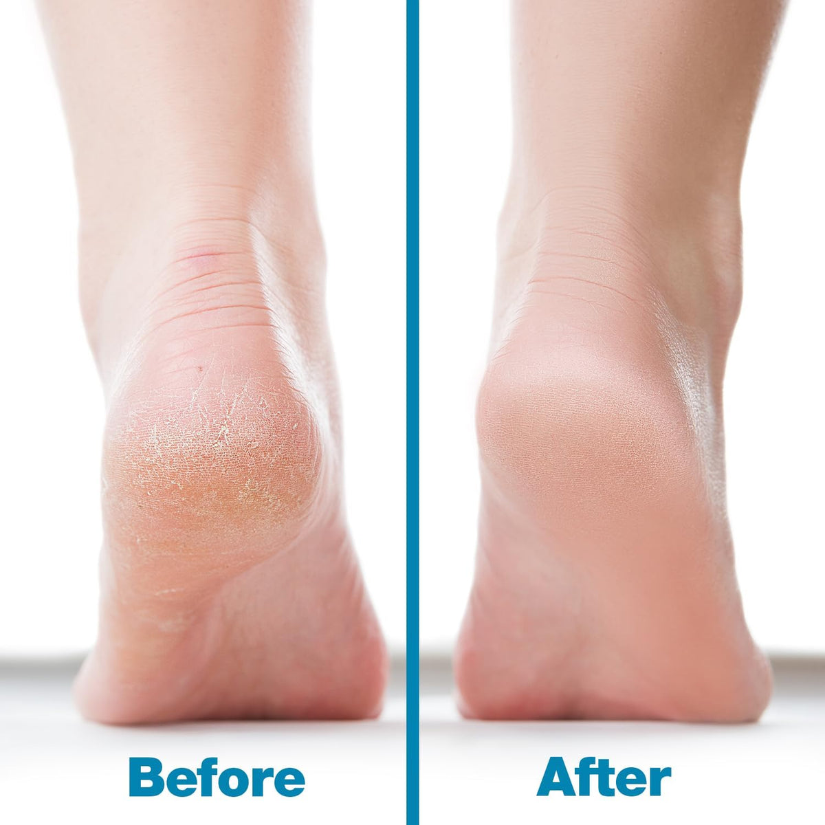 Probelle Double Sided Multidirectional Nickel Foot File Callus Remover - Immediately Reduces