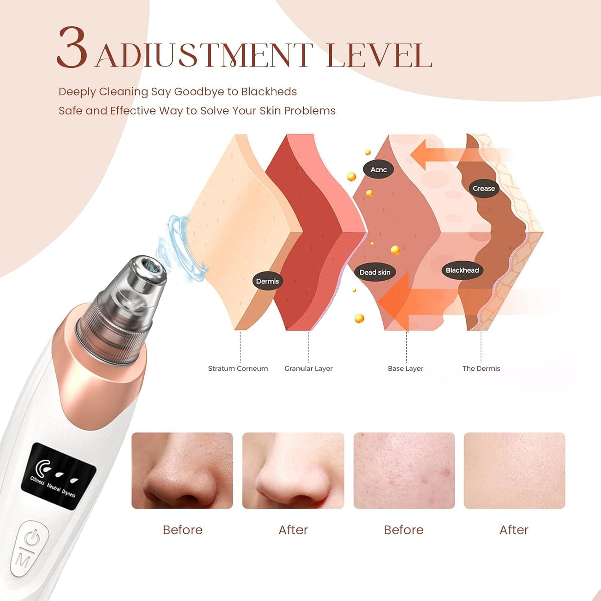 2025 Blackhead Remover Pore Vacuum,Facial Pore Cleaner-5 Suction Power,5 Probes,USB Rechargeable