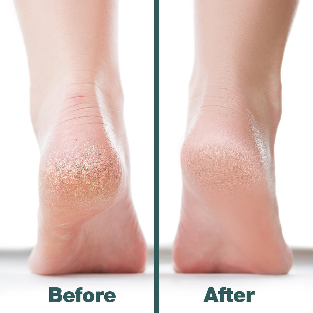 Probelle Double Sided Multidirectional Nickel Foot File Callus Remover - Immediately Reduces