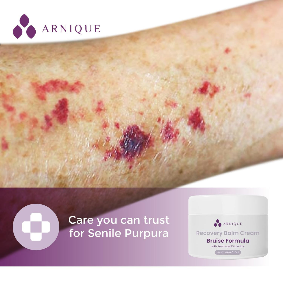 Arnica Bruise Cream with Vitamin K, Extra Strength Fast Healing Thin Skin Formula, Senile Purpura