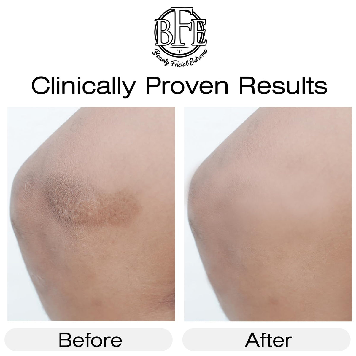 Vitamin K Cream- Moisturizing Bruise Healing Formula. Dark Spot Corrector for Bruising, Spider