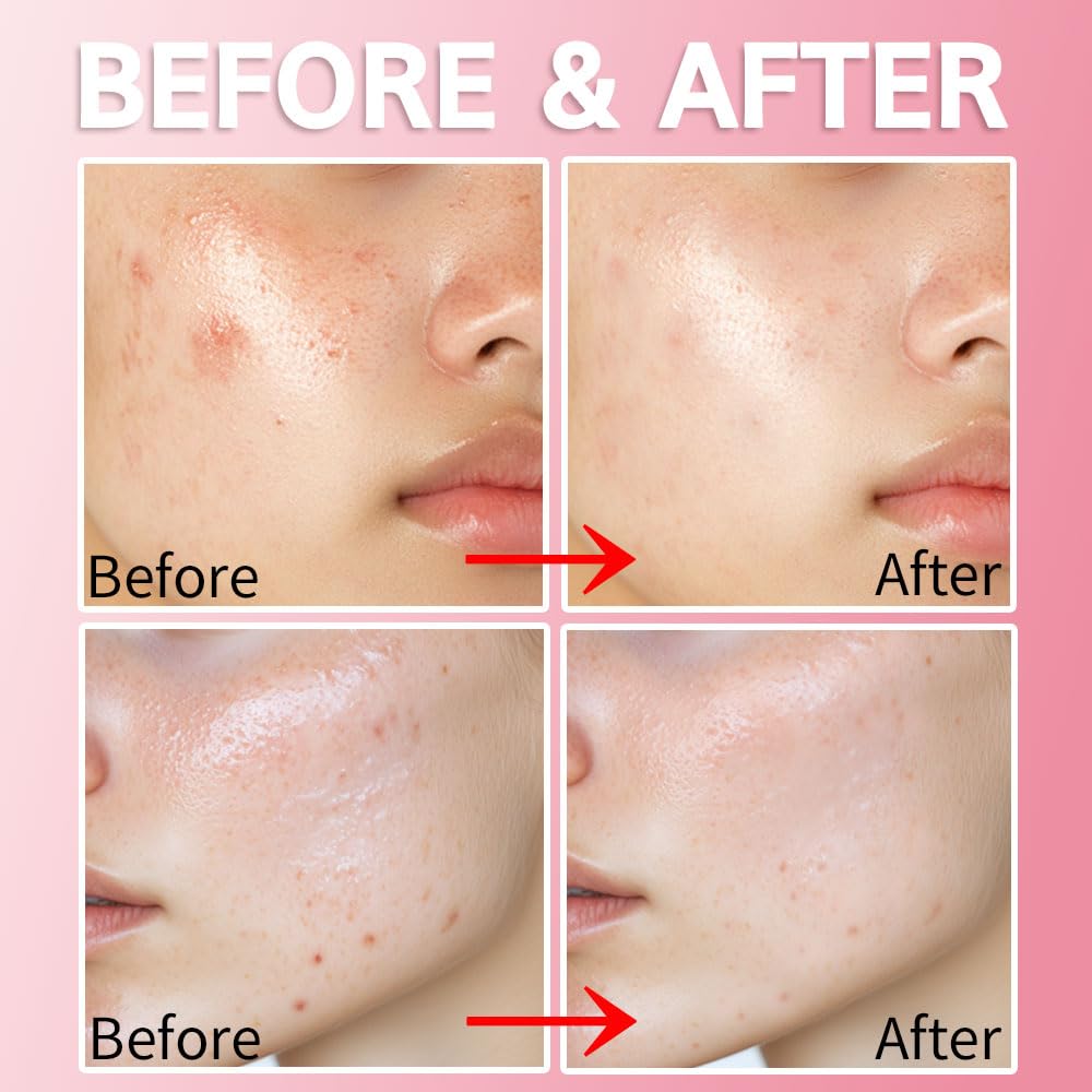 Purederm Blemish Spot Treatment Gel with Salicylic Acid 2%, Soothing Acne Care for Irritated Skin