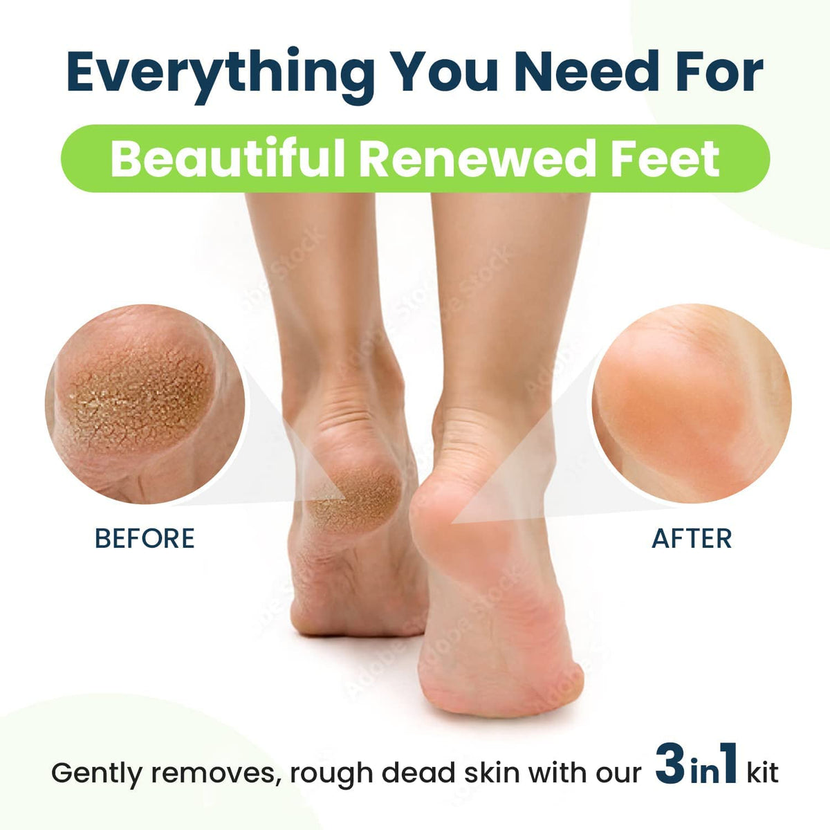 Callus Remover for Feet with Extra Strength Gel & Foot Pumice Stone Set - Easy Way to Remove Hard