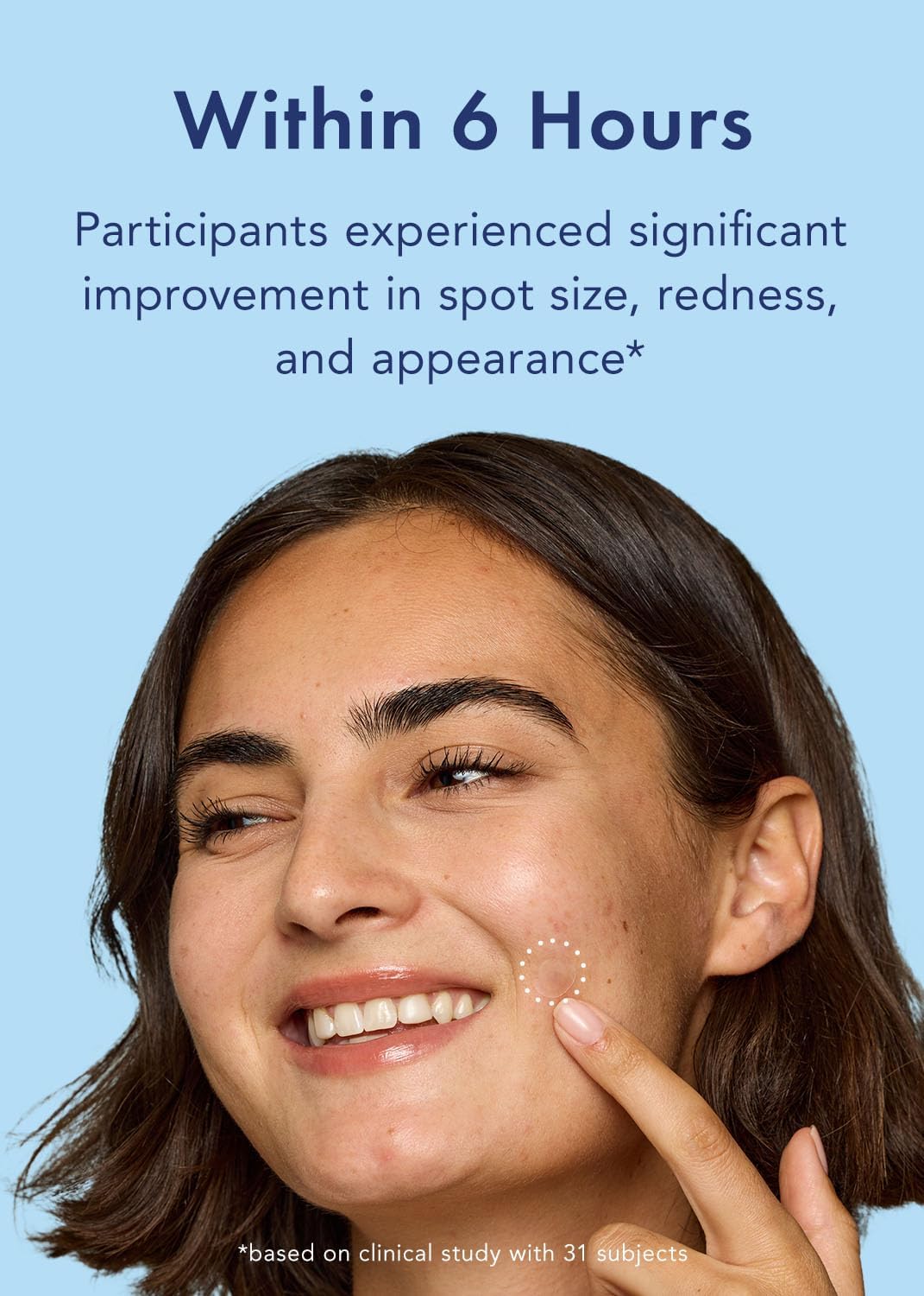 Rael Pimple Patches, Miracle Retinol Spot Cover - Hydrocolloid Acne Patch for Face, Absorbing Zits