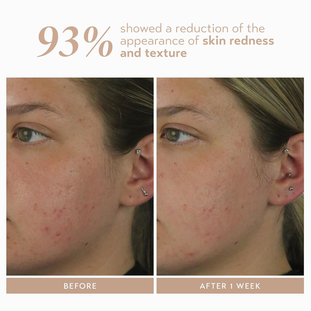 Shani Darden Rescue Serum with 10% Azelaic Complex, Lightweight Hydrating Azelaic Acid Serum for