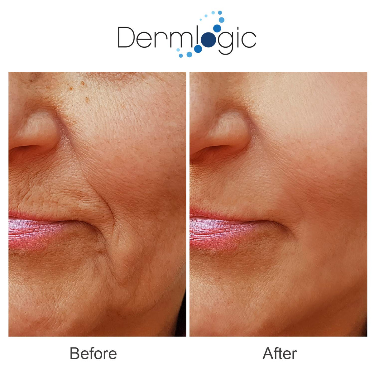 Anti Aging Resurfacing Peel Pads- Triple Action Chemical Peel Pads Combined with Glycolic, Lactic