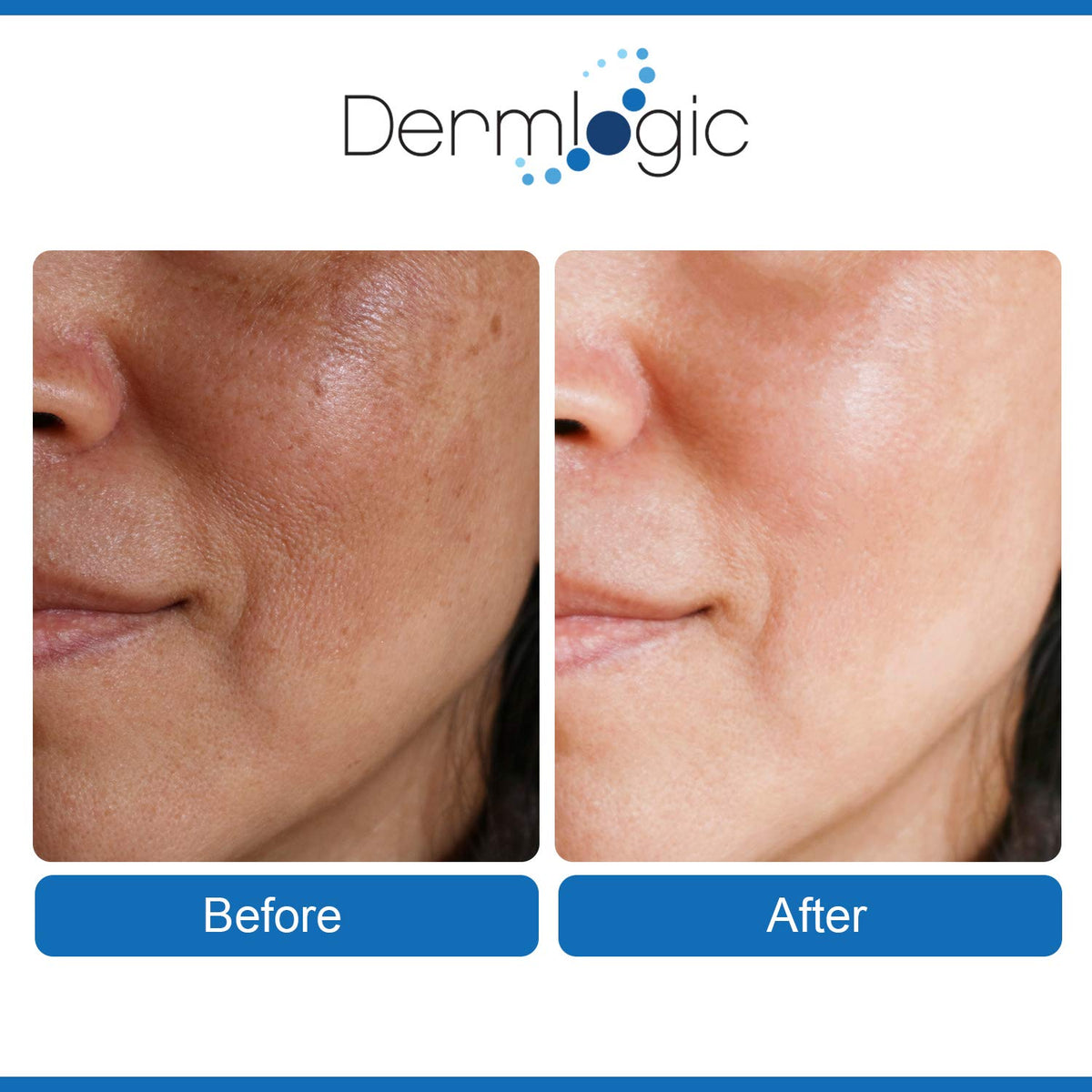 Anti Aging Resurfacing Peel Pads- Triple Action Chemical Peel Pads Combined with Glycolic, Lactic