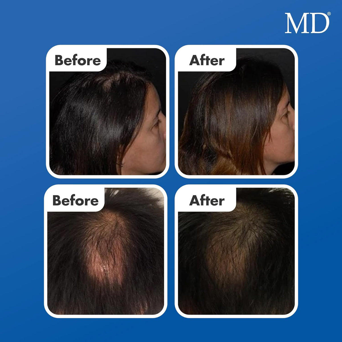 MD Follicle Energizer | Natural Hair Growth Serum | Biotin Infused to Block DHT Production and