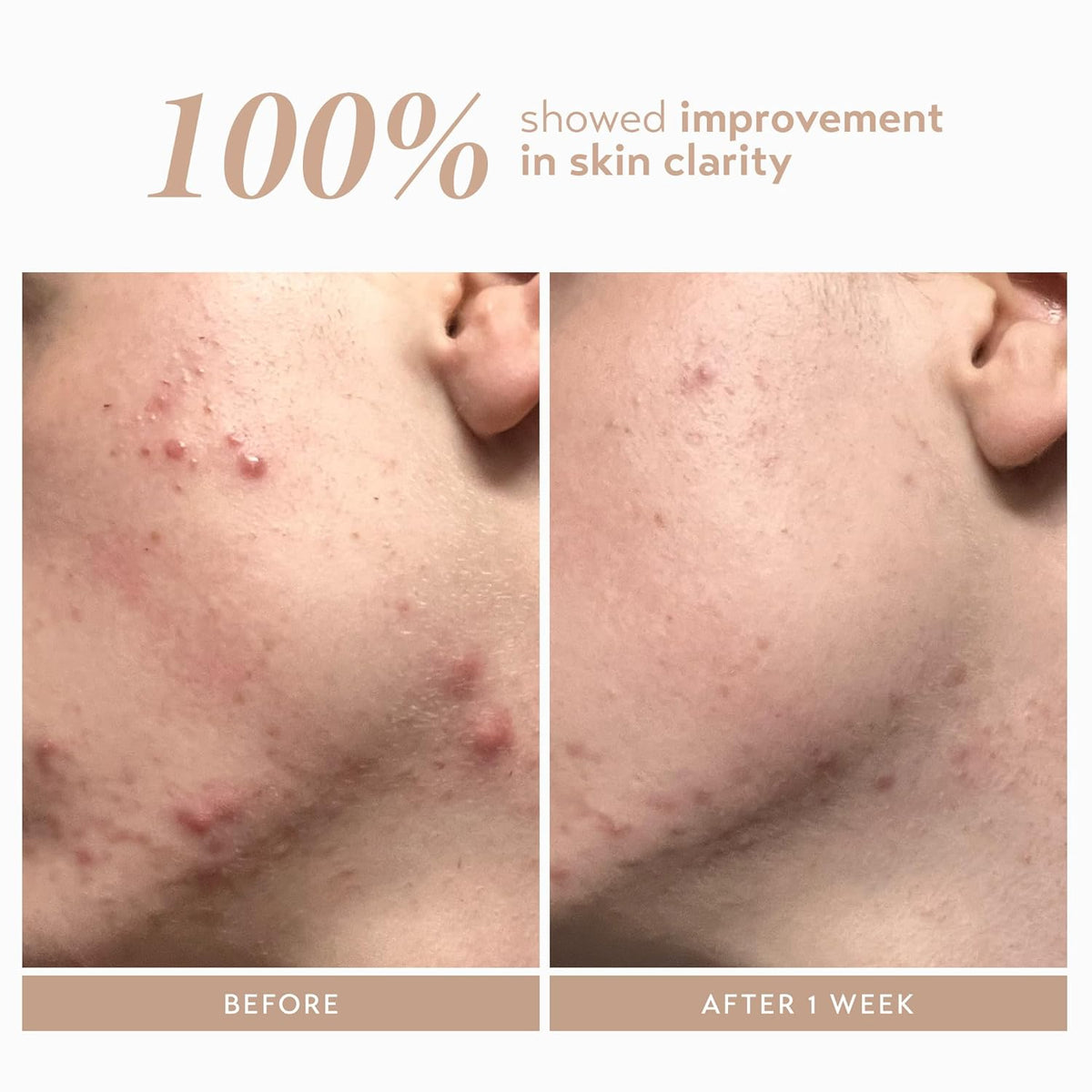 Shani Darden Rescue Serum with 10% Azelaic Complex, Lightweight Hydrating Azelaic Acid Serum for