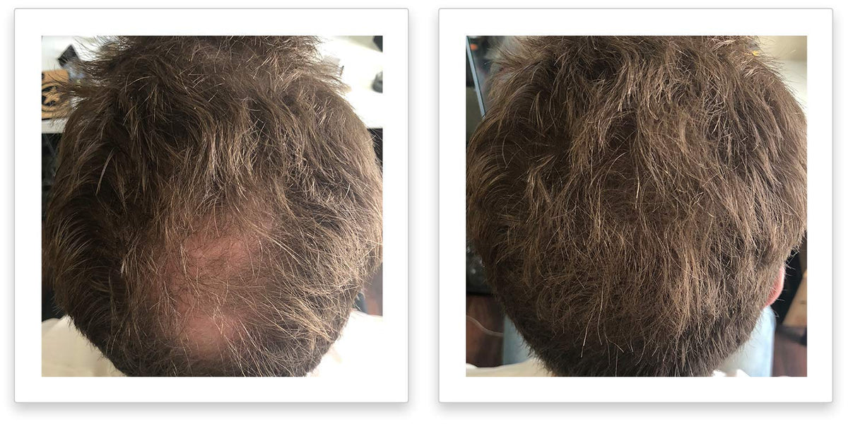 FEBRON Hair Fibers For Thinning Hair For Women & Men Hair Loss Concealer Hair Powder Volumizing