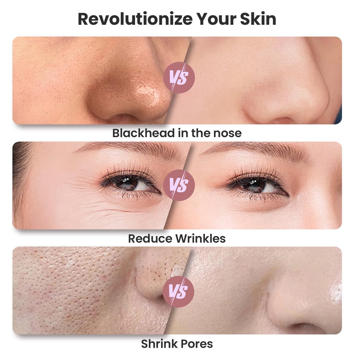 Diamond Microdermabrasion Machine, Portable Blackhead Remover Pore Vacuum, Dermabrasion Facial