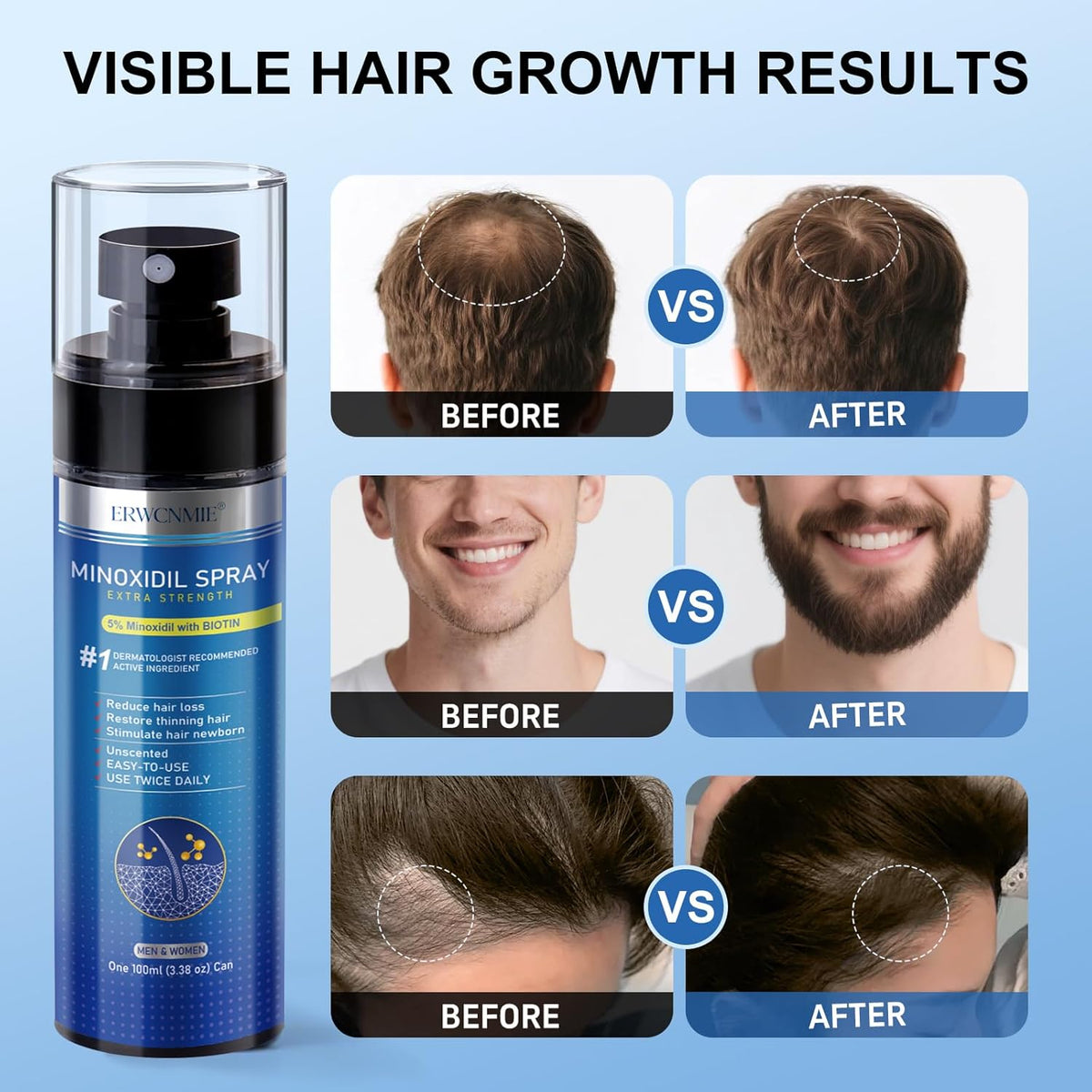 5% Minoxidil Spray for Men and Women-7 pack, Infused with Biotin, Beard Growth, Extra Strength