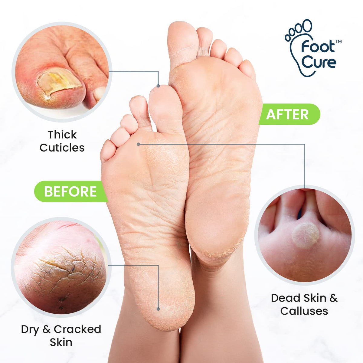 Tea Tree Foot Soak & Callus Remover Gel Kit - Extra Strength Callus Remover Gel & Foot Soak With