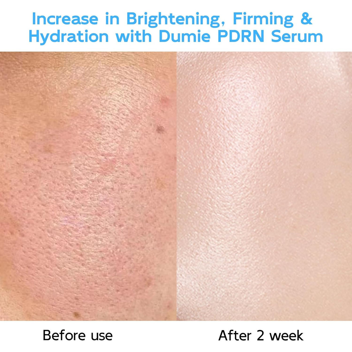 Salmon DNA PDRN Anti-Aging Serum, 5000ppm Salmon Egg DNA Ampoule, 2000ppm Collagen, Glutathione
