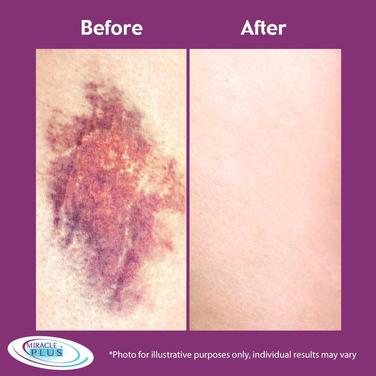 Miracle Plus Arnica Cream Bruise Relief Lotion + Arnica Bruise Gel For Bruising And Swelling On