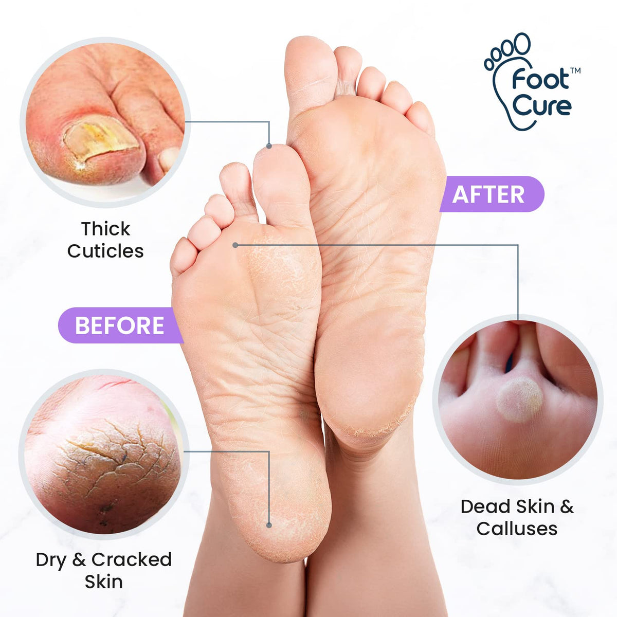 Lavender Foot Soak & Callus Remover Gel Kit - Extra Strength Callus Remover Gel for Feet, Remove