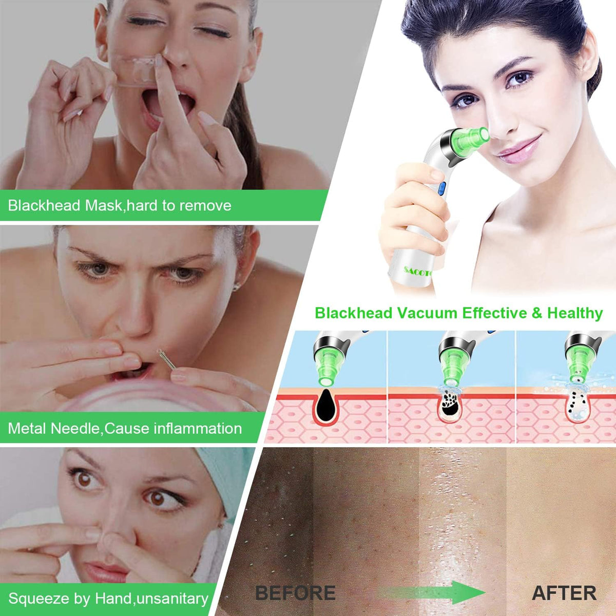 Blackhead Remover Pore Vacuum, Face Suction Pore Cleanser, 5 Suction Power Electric Blackhead