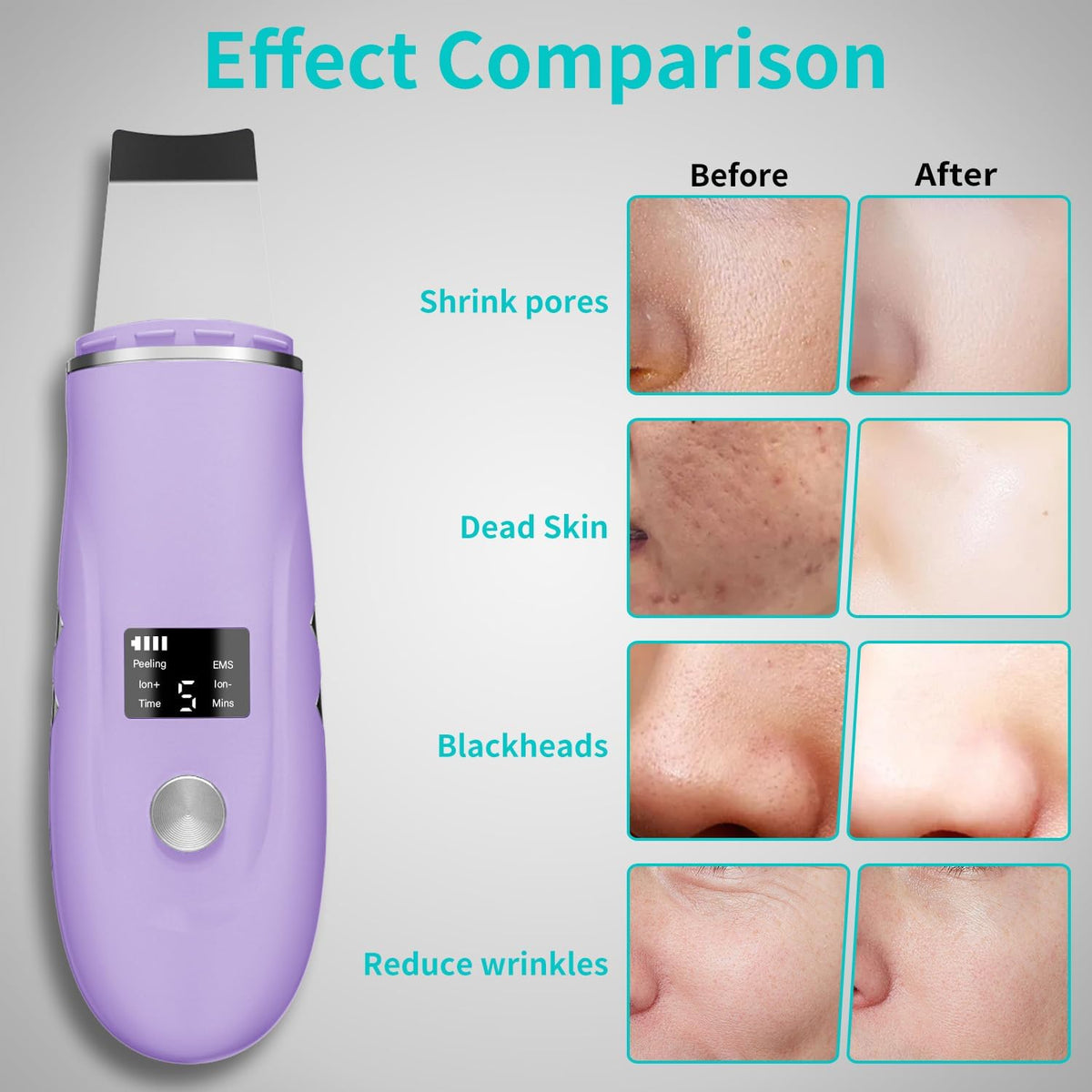Face Scrubber Skin Spatula - Blackhead Remover Deep Cleansing Tool for Pore Extraction, 4-in-1 Fast