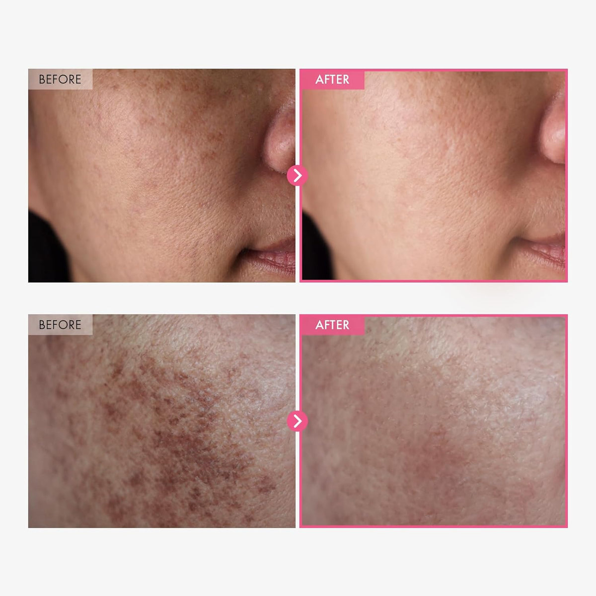 Arbutin 7% + Tranexamic Acid 4% Cream, 70,000ppm Arbutin, 40,000ppm TXA, Niacinamide, Glutathione