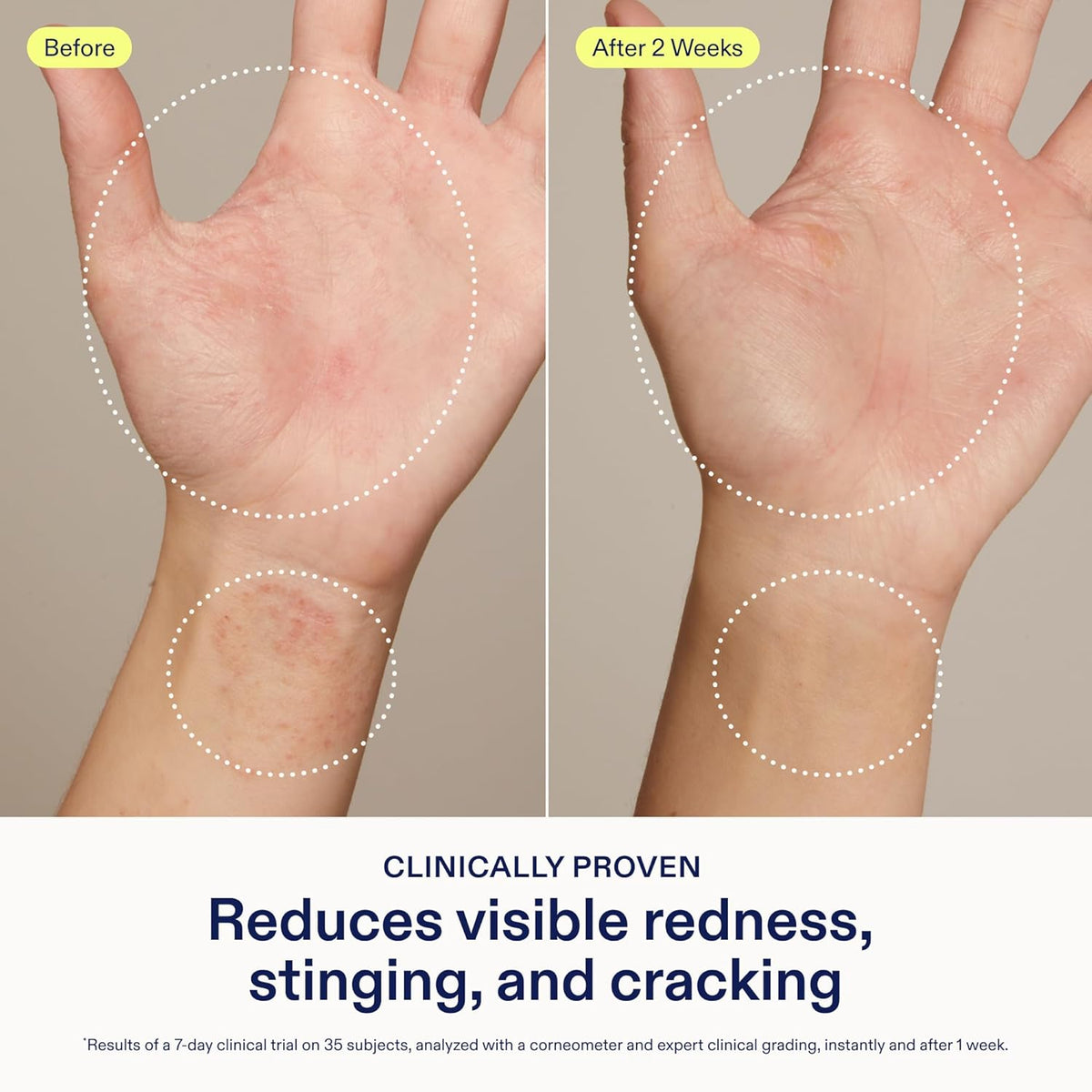 Skinfix Hand Relief Cream - 3 fl oz - Reduces Visible Redness, Stinging & Cracking for Dry