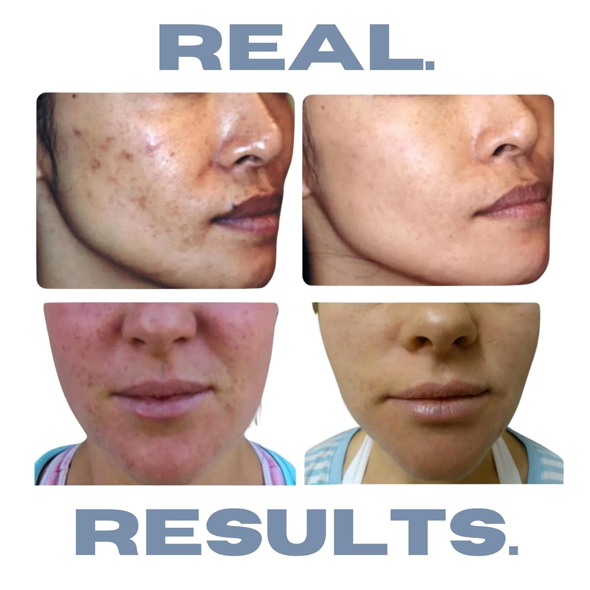 Clarifying Toner for Acne and Blemishes, Face Toner, Facial Toner, Skin Toner, Acne Toner, Toner