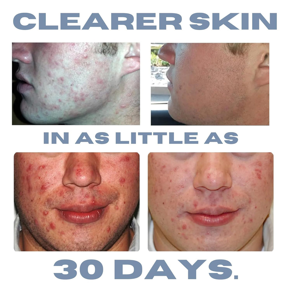 Acne Treatment Kit, Acne Kit, Skin Care Acne, Acne Skin Care Set, Natural Anti-DHT Deluxe Set