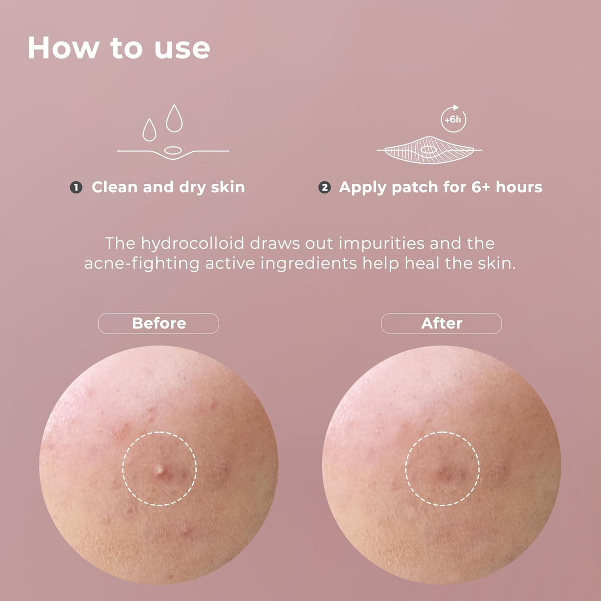 OMMA Korean Pimple Patches for Face with Hydrocolloid Patch, Invisible Blemish Pimple Stickers Acne