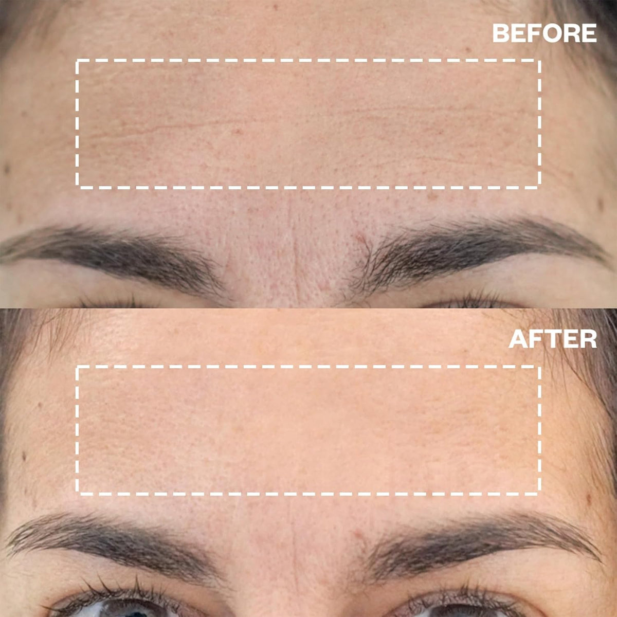 Wrinkles Schminkles Forehead Wrinkle Patches, 2-Pack, Reusable Hypoallergenic Silicone Smoothing