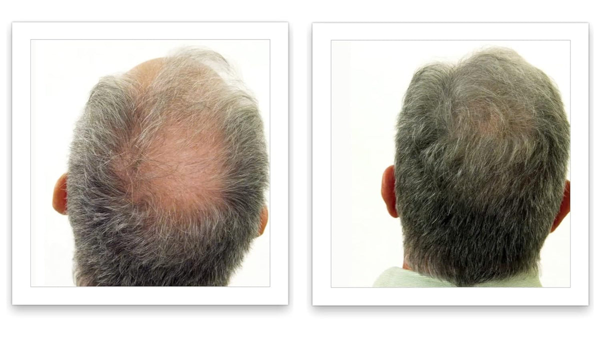 Caboki Hair Loss Concealer. All-Natural Hair Building Fiber. Make Thin Hair Look 10X Fuller
