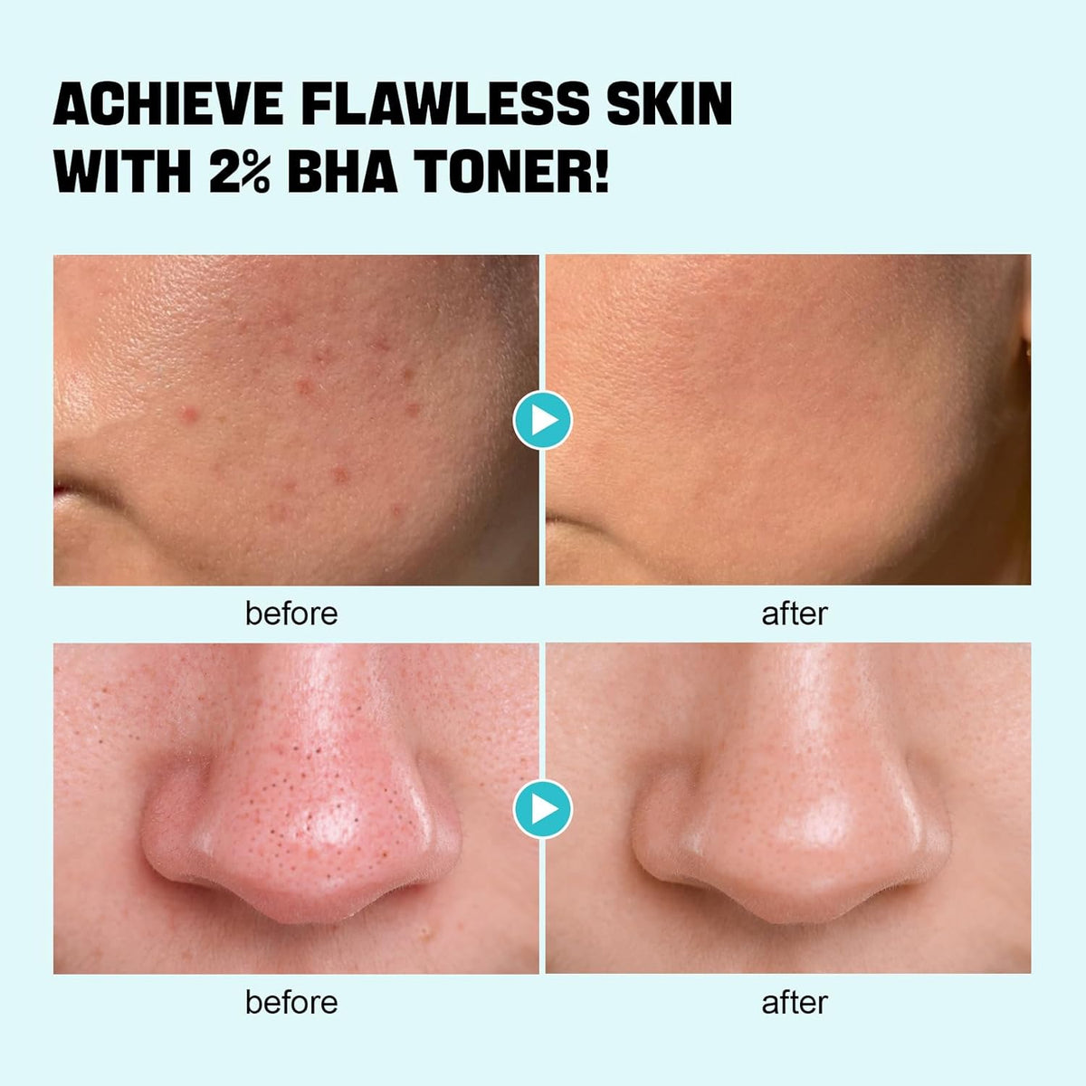 Salicylic Acid Toner, Blackhead Remover, BHA Liquid Exfoliant (CICA, 6.76OZ), ZealSea Pore