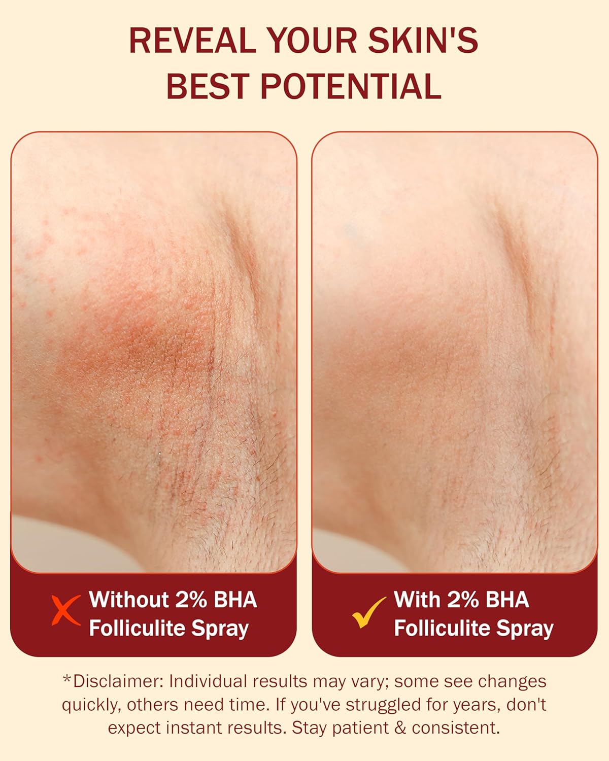 Folliculitis Treatment 2% BHA Body Spray - Salicylic Acid with Tea Tree Oil & Aloe Vera - Spray