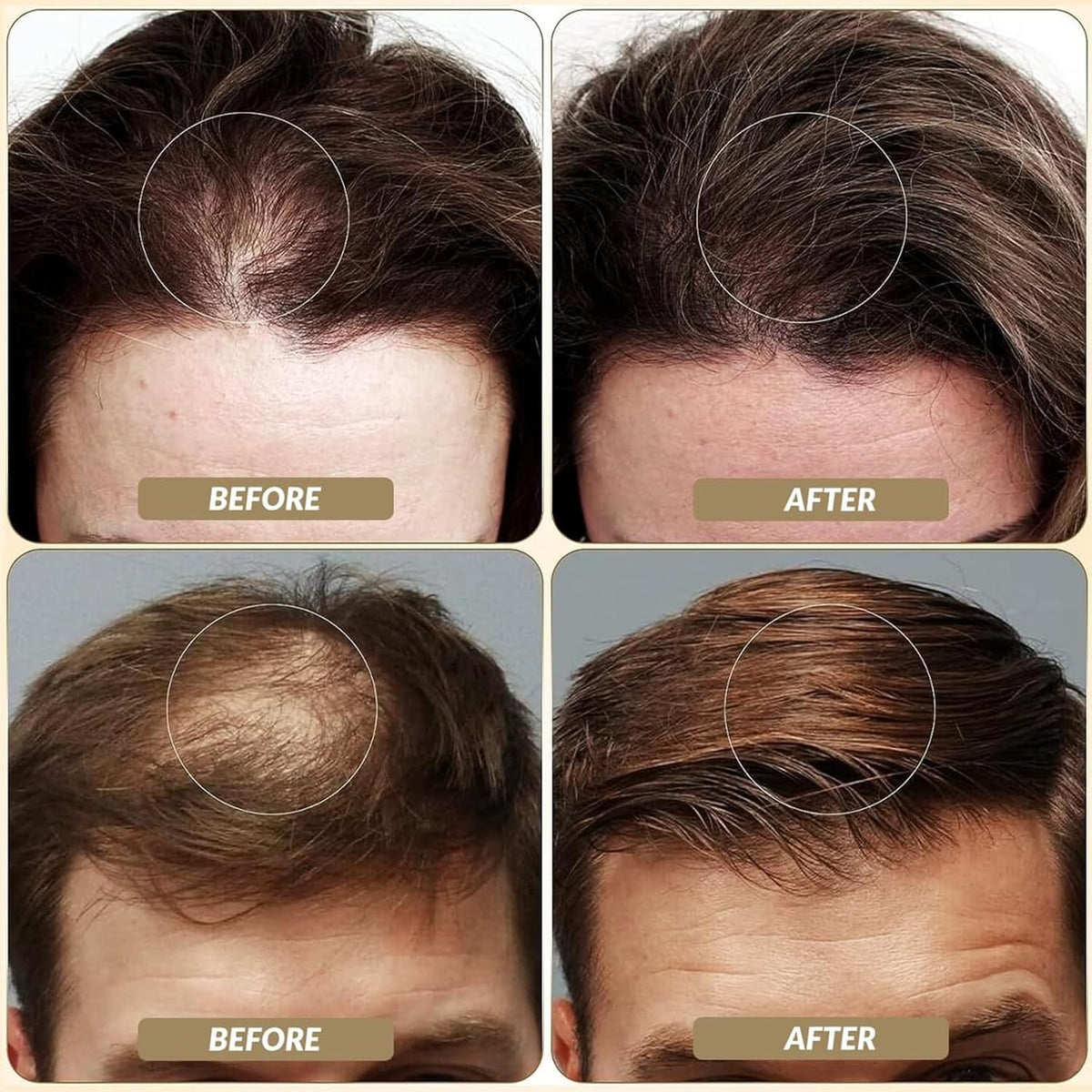 SOVONCARE Hair Fibers for Thinning Hair Medium Brown, Hair Building Fibers for Bald Spots