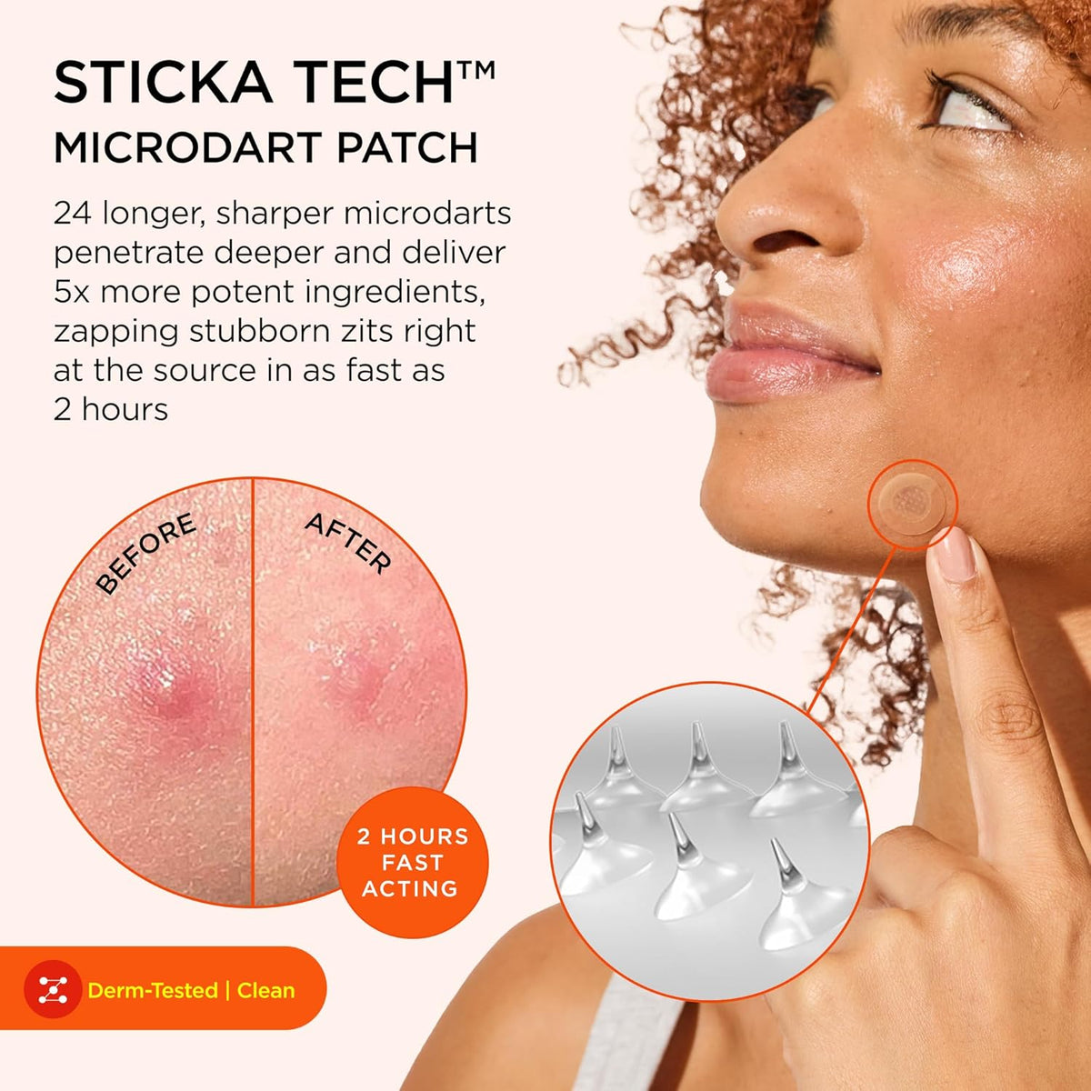 ZitSticka Extra Strength Killa Acne Patches for Face - World's Most Potent Pimple Patch with