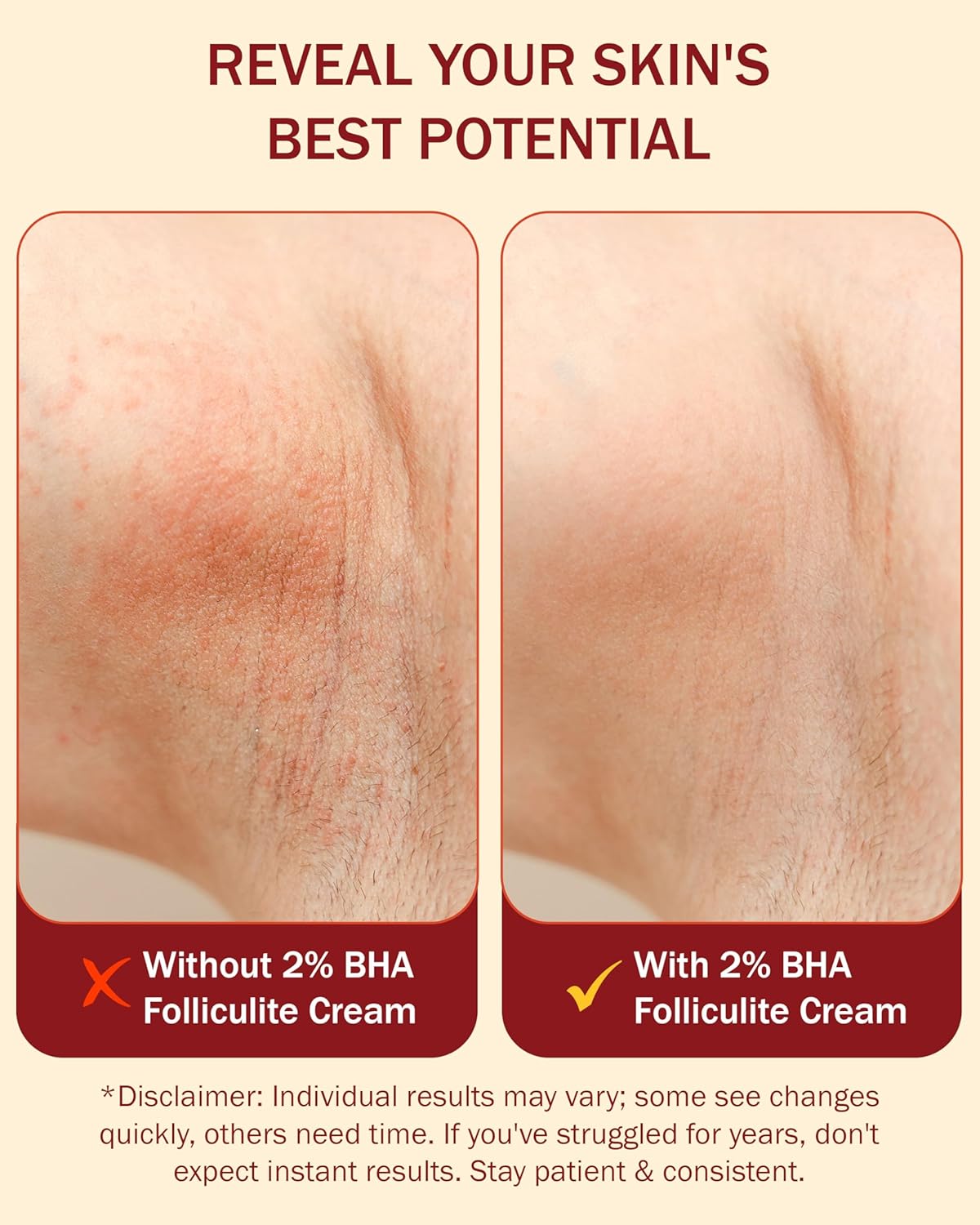 Folliculitis Cream – Folliculitis Treatment for Red Bumps, Ingrown Hairs & Razor Irritation – 2%