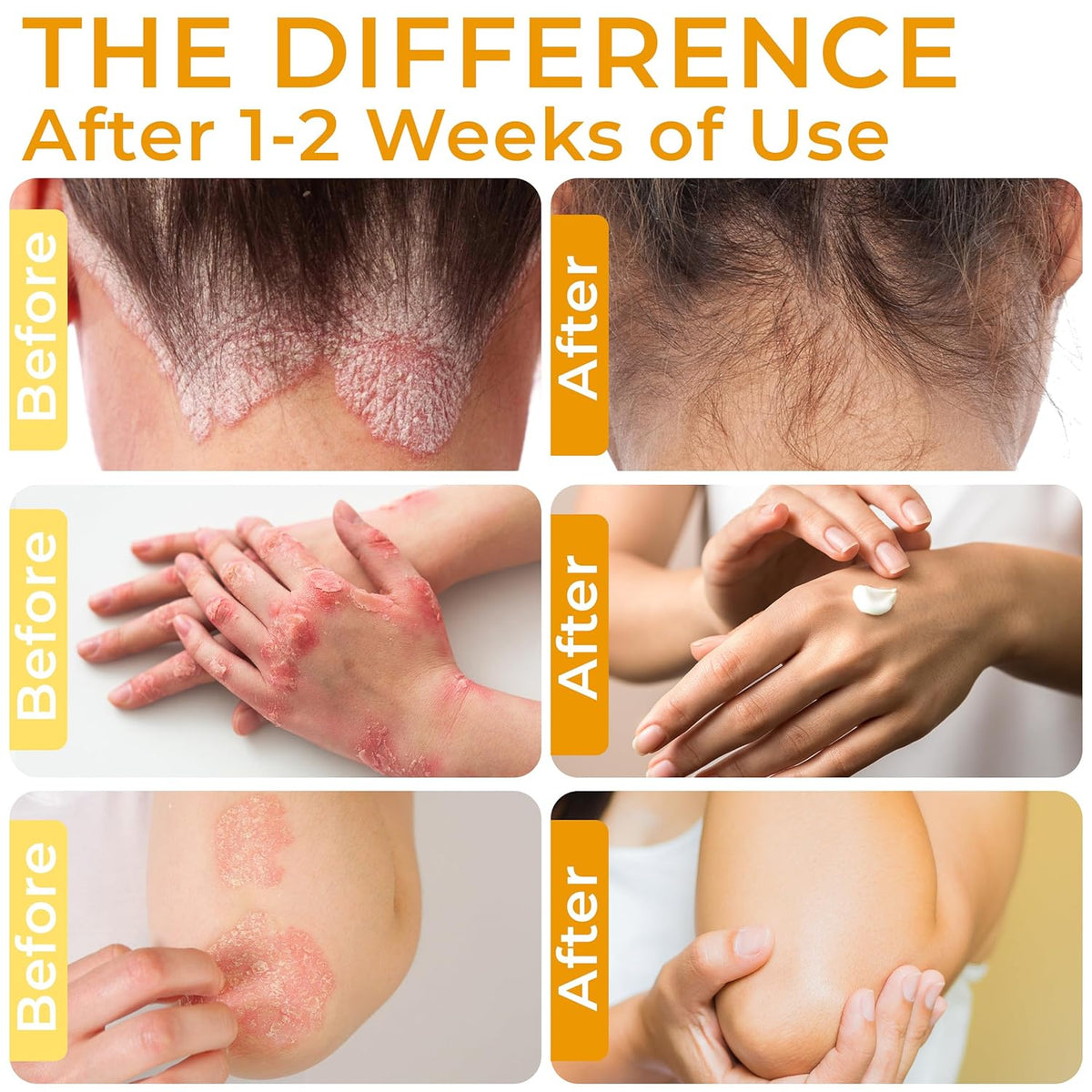 Psoriasis Cream for Itchy Scalp, Face & Body | Eczema Cream for Adults | Psoriasis Treatment for