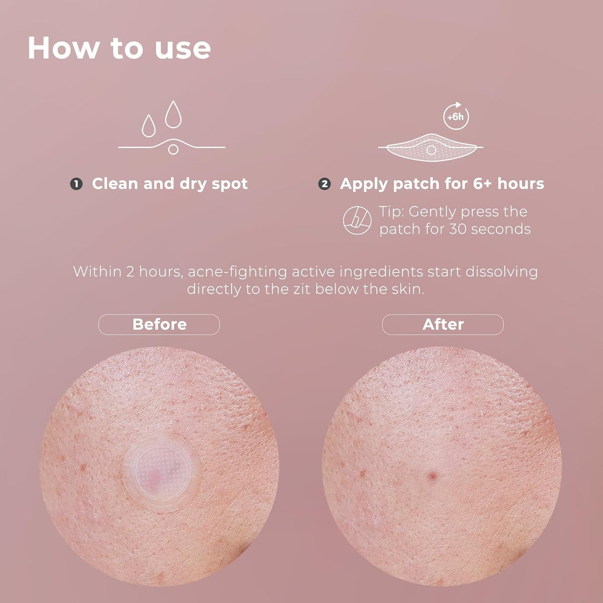 OMMA Korean Microdart Acne Patch, Cystic Acne Treatment, Micropoint Pimple Patches for Face for